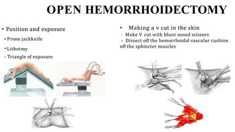 Hemorrhoidectomy Surgical Procedure Raf Pptx