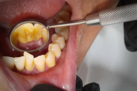 C Mo Prevenir La Gingivitis