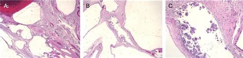 Low Power Microscopy Showing Variable Sized Cystic Spaces A Low Power