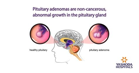 Pituitary Gland Tumors - Important Things To Know About