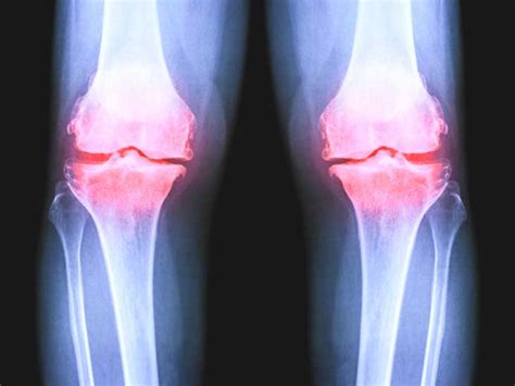 osteoarthritis   knee  ray