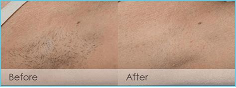 Laser Hair Removal in Kerrville, TX | McRae MD Medical Laser Center
