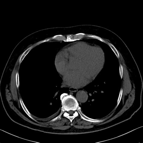 Annular Pancreas Radiopaedia Axial Thick Nc Commons