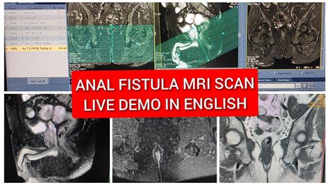 Anal Fistula Perianal Fistula MRI Scan Protocol Positioning And