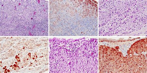 β Catenin Expression In Conjunctival Melanoma A Vertical Growth Phase