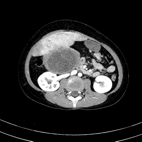 Undifferentiated Embryonal Sarcoma Of The Liver Image