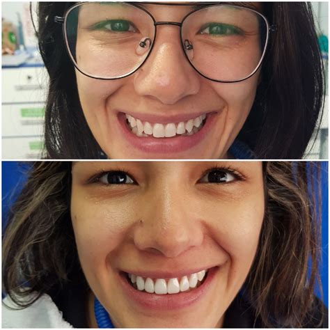 Diseño De Sonrisa Digital Clínica Dental Odontologists