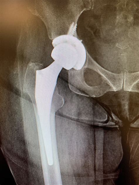 Case Study Revision Total Hip Replacement In A Year Old Isolated