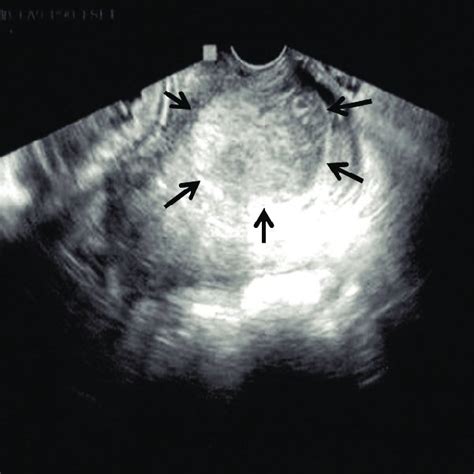 Transvaginal Sonogram Showed 52 × 32 Mm Sized Hematoma Arrow In The