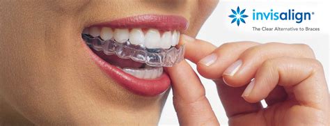 Free Dental Consultation Invisible Braces Invisalign Auckland