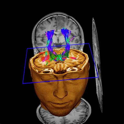 Brain Tumour Photograph By Simon Fraser Science Photo Library Pixels