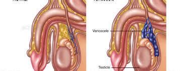 Solution Varicoc Le Excellent Traitement Naturel Recette Plante