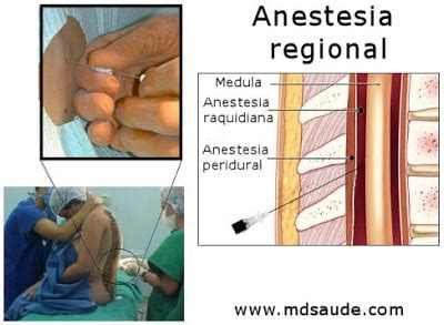 Tipos De Anestesia Geral Local Raquidiana E Peridural