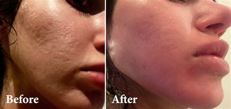 Treating Acne Scars With Co Laser Therapy Lmc