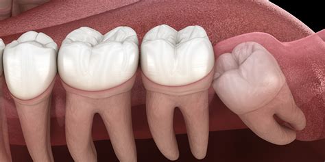 CBCT Scan For Impacted Tooth Oral Radiology Toronto