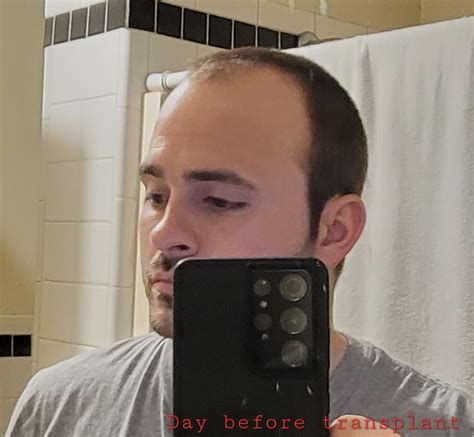 3 month Hair Transplant Update, 2100 grafts. : r/Hairtransplant