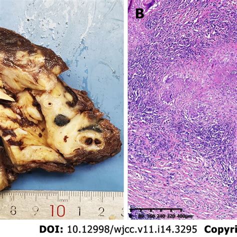 Macroscopic And Microscopic Features Of The Left Lower Lobe Mass A