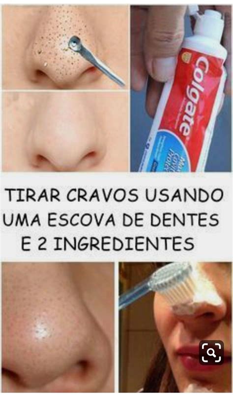 Aprender Sobre 92 Imagem Como Tirar Cravo Br Thptnganamst Edu Vn