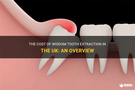 The Cost Of Wisdom Tooth Extraction In The Uk An Overview MedShun