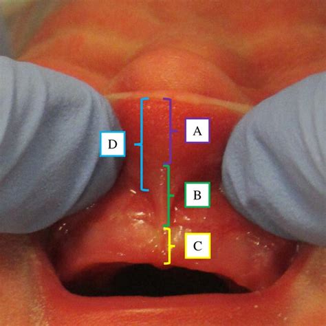 Stanford Superior Labial Frenulum Classification Type 1 Insertion Of Download Scientific