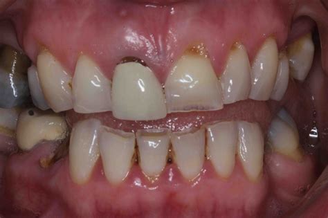 Dental Implants Before And After Lane Ends Dental Practice Preston