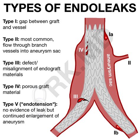 Types Of Endoleaks RK MD