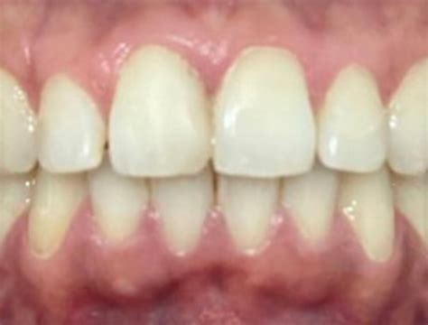 Case 15 Smile 360 Dental Dentists In Harrow Greater London