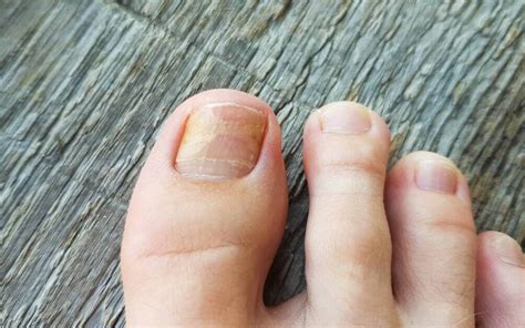 Toenail Ripped Off Grow Back Nail Ftempo