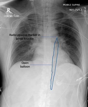 Aortic Balloon Pump Placement