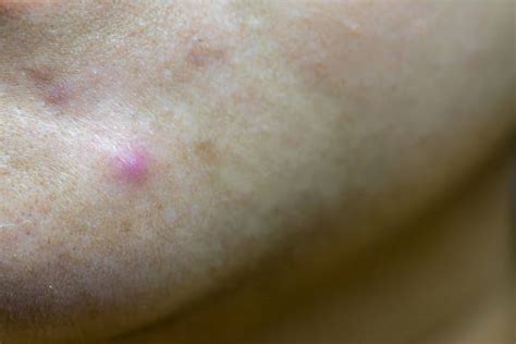 Smallpox Pustules Stock Photos, Pictures & Royalty-Free Images - iStock