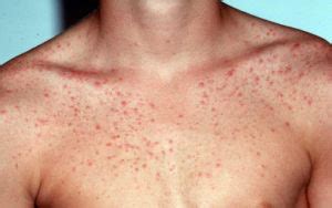 HealthoolPityrosporum folliculitis rash on a patient’s chest and ...