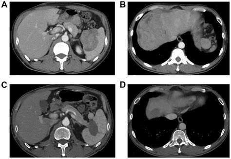 Pancreatic Acinar Cell Carcinoma Presenting With Panniculitis