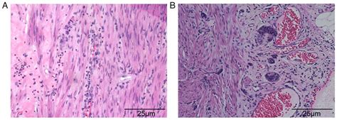 Hematoxylin And Eosin Staining Showing A Inflammatory Cell