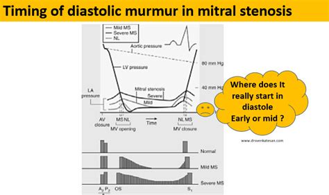 Mitral Stenosis Drsvenkatesan Md