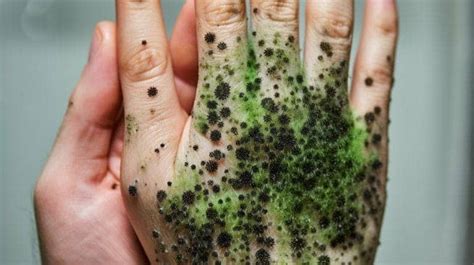 Mold On Skin: Causes, Symptoms, And Treatment Options