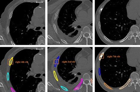 Development And Evaluation Of A Deep Learning Algorithm For Rib