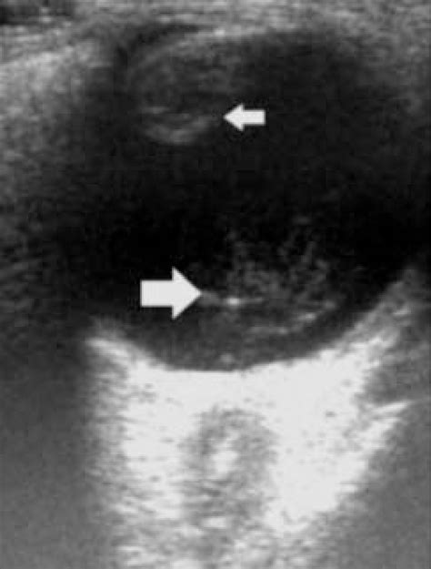 Cataract B Scan Reveals A Cataractous Lens Small Arrow Associated