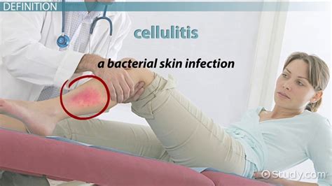 What Is Cellulitis Definition Causes Symptoms And Treatment Lesson