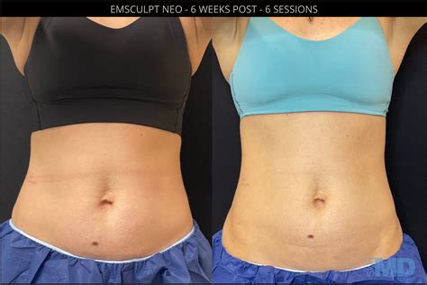 EMSCULPT NEO Boston Skin MD Laser Cosmetic Group