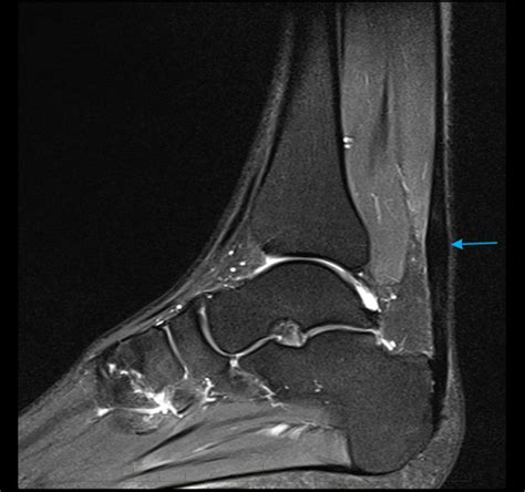 MRI Achilles Tendon - Melbourne Radiology