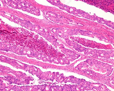 Adenocarcinoma In Human Colon Light Micrograph Stock Image C