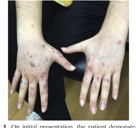 Figure 1 from A case report on variegate porphyria after etonogestrel placement | Semantic Scholar