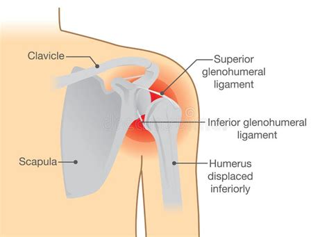 Shoulder Dislocation Anterior Dislocation Posterior Dislocation Labeled Stock Illustration