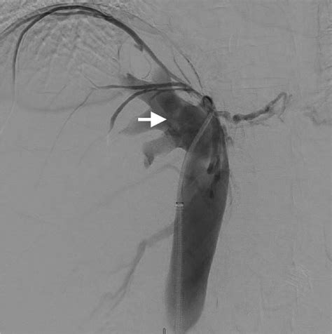 Ivc Venogram During Attempted Sharp Recanalization Shows Complete