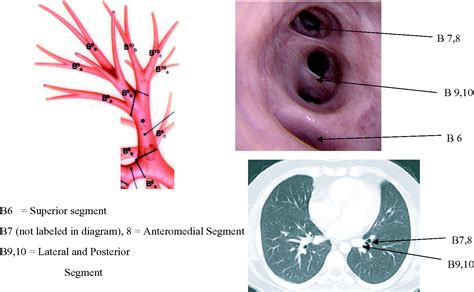 Bronchoscopic Anatomy - Anatomical Charts & Posters