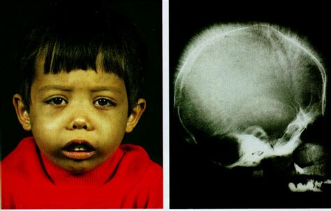 Characteristic Physical Features In Beta Thalassemia Medizzy