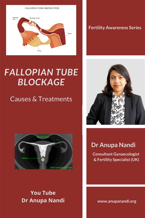 Fallopian tube blockage causes treatment – Artofit