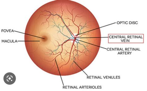 Visual Disturbances Retinal Artery Occlusion Flashcards Quizlet