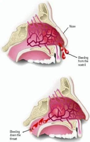 Nosebleed Treatment in Jaipur | ID: 14505102591