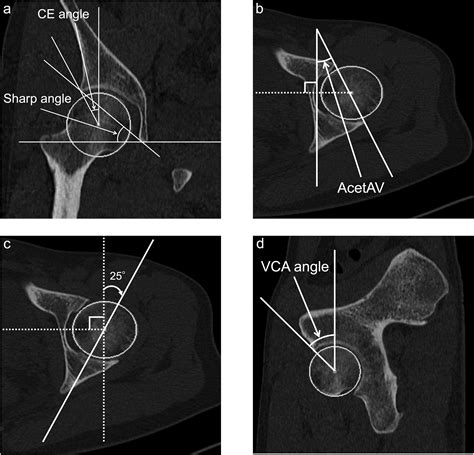 Sex Differences In Reference Values Of Hip Acetabular Measurements